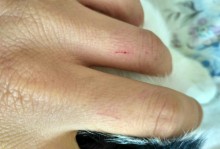 被宠物猫抓伤-被宠物猫抓伤出血要打针吗
